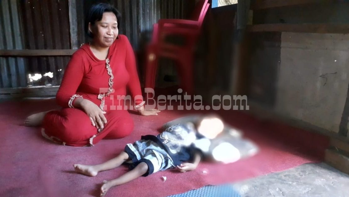 anak menderita polio